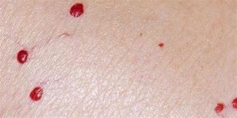 血痣和红痣有什么区别_血痣和红痣的区别图片,第2张 血痣和红痣有什么区别_血痣和红痣的区别图片,第2张